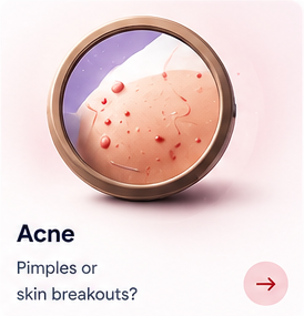 Acne